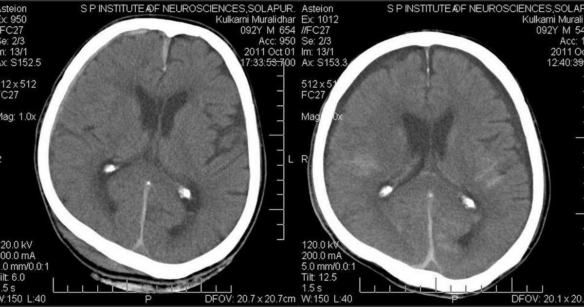Neuroradiology Cases: Post traumatic Subdural Hygroma